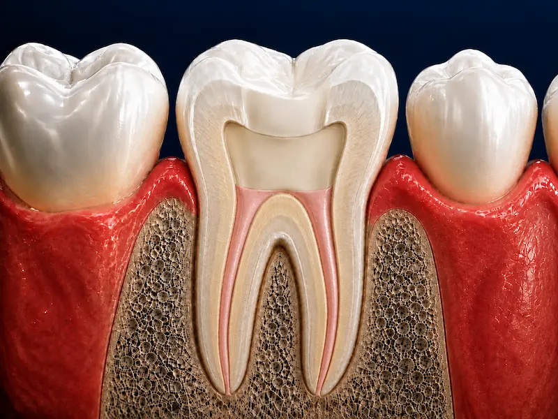 Root Canal Treatment in Tijuana - After Tooth after root canal treatment with cleaned and filled canals in Tijuana