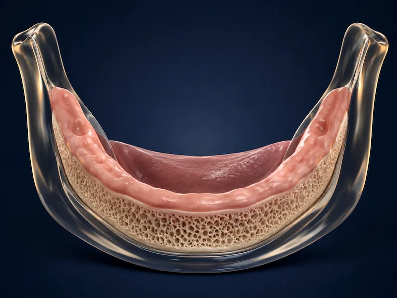 All-on-4 Dental Implants Tijuana - Before Edentulous lower jaw before All-on-4 dental implant treatment in Tijuana