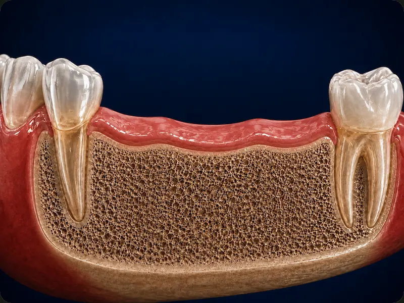 Implant-Supported Bridge in Tijuana - Before Three missing lower teeth before implant-supported bridge treatment in Tijuana