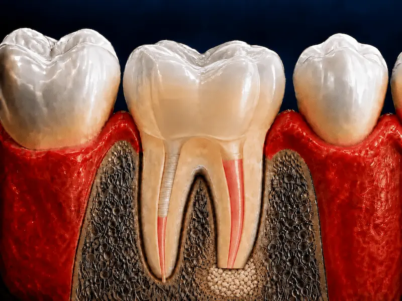 apicoectomy-tijuana-after Tooth after apicoectomy with the affected root tip removed and bone graft placed in Tijuana