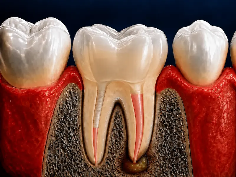 apicoectomy-tijuana-before Root canal-treated tooth with a localized periapical infection before apicoectomy in Tijuana