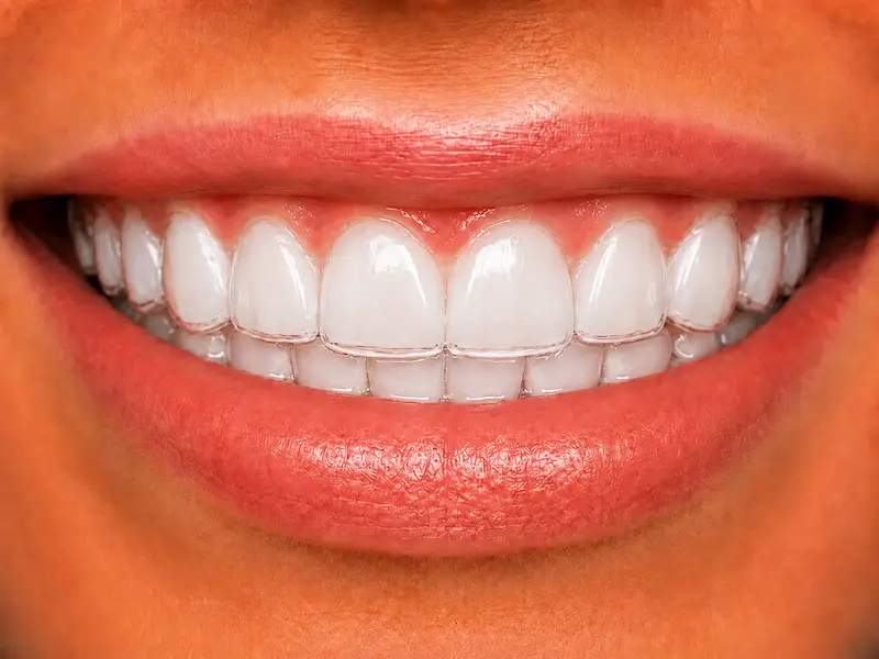 clear-aligners-tijuana-after Teeth wearing clear orthodontic aligners during treatment in Tijuana