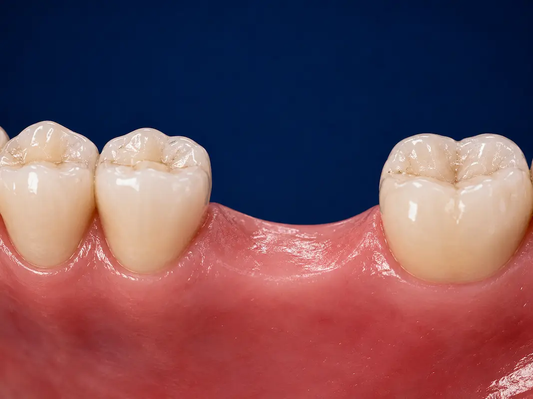 dental-bridge-tijuana-before Missing lower first molar before dental bridge treatment in Tijuana