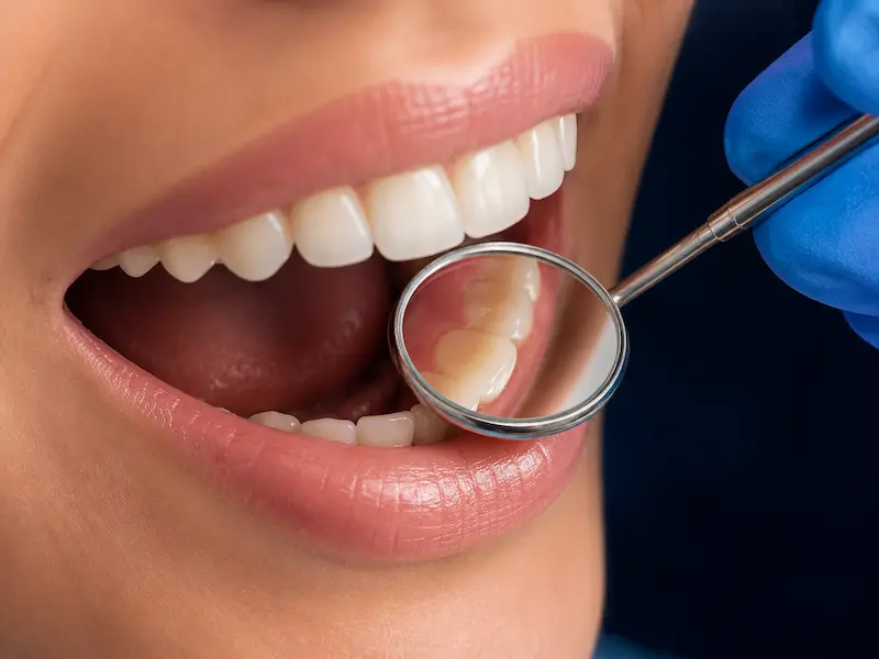 dental-checkup-tijuana Dental checkup with mouth mirror during a routine exam in Tijuana