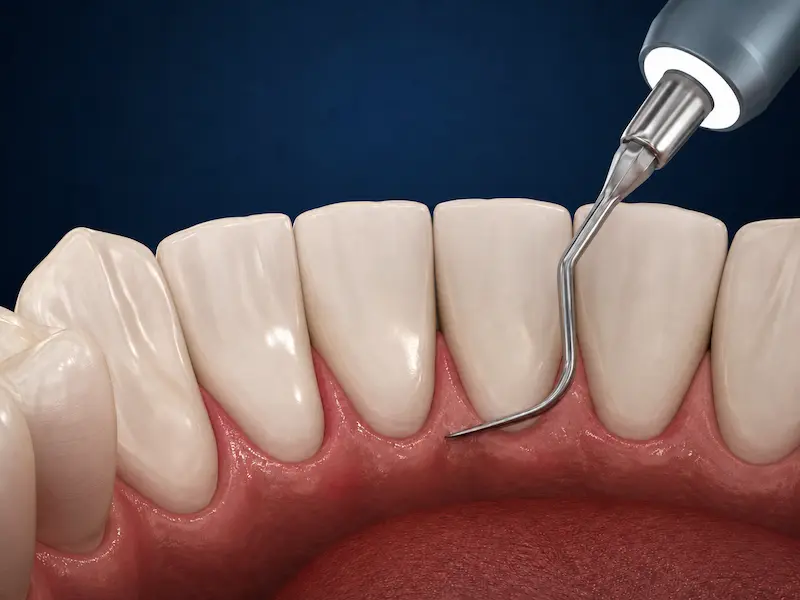 dental-cleaning-tijuana-after Clean lower front teeth after professional dental cleaning in Tijuana