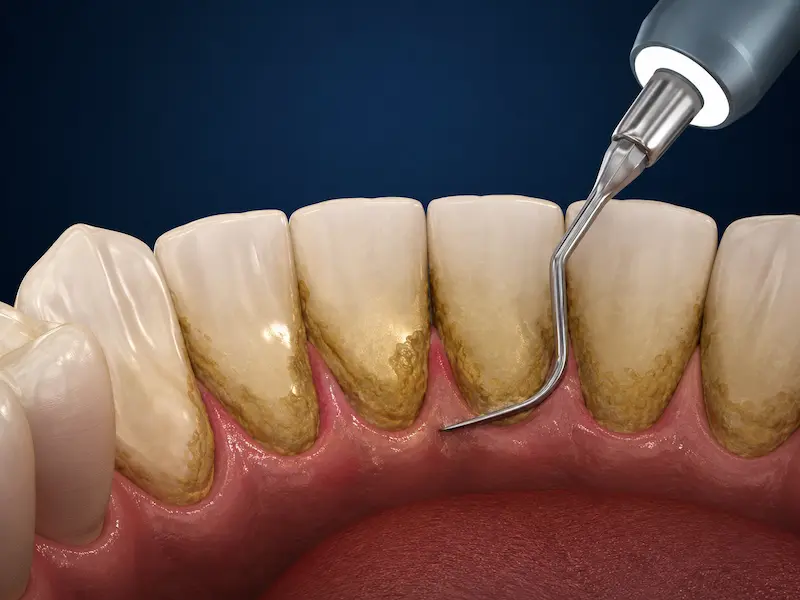 dental-cleaning-tijuana-before Tartar buildup on lower front teeth before dental cleaning in Tijuana