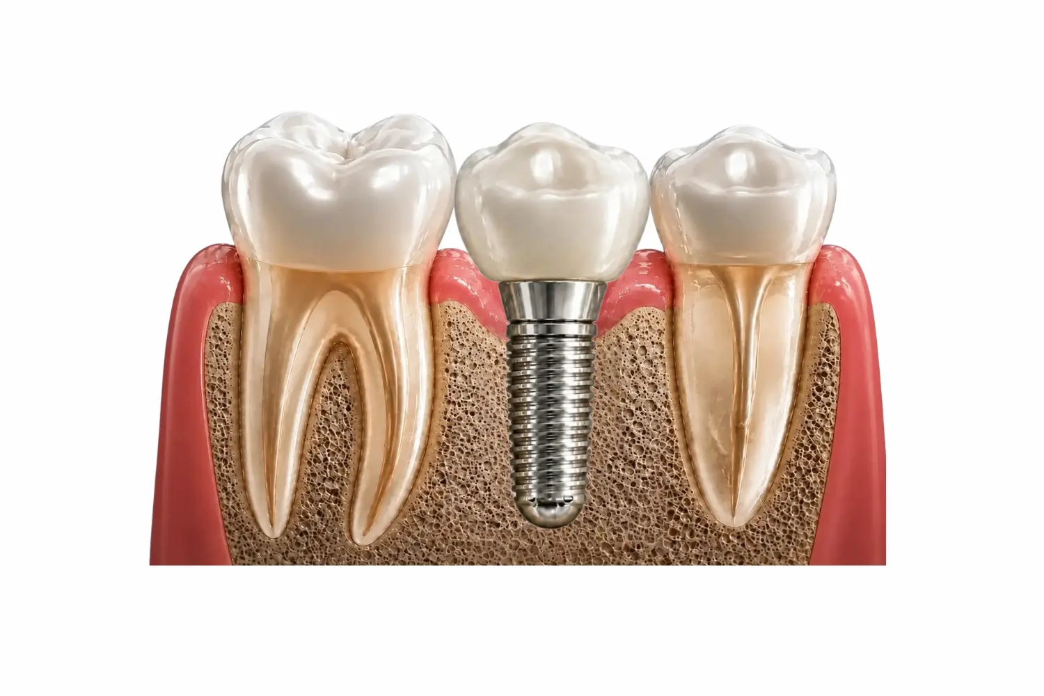 Dental implant restoration after replacing a missing tooth in Tijuana