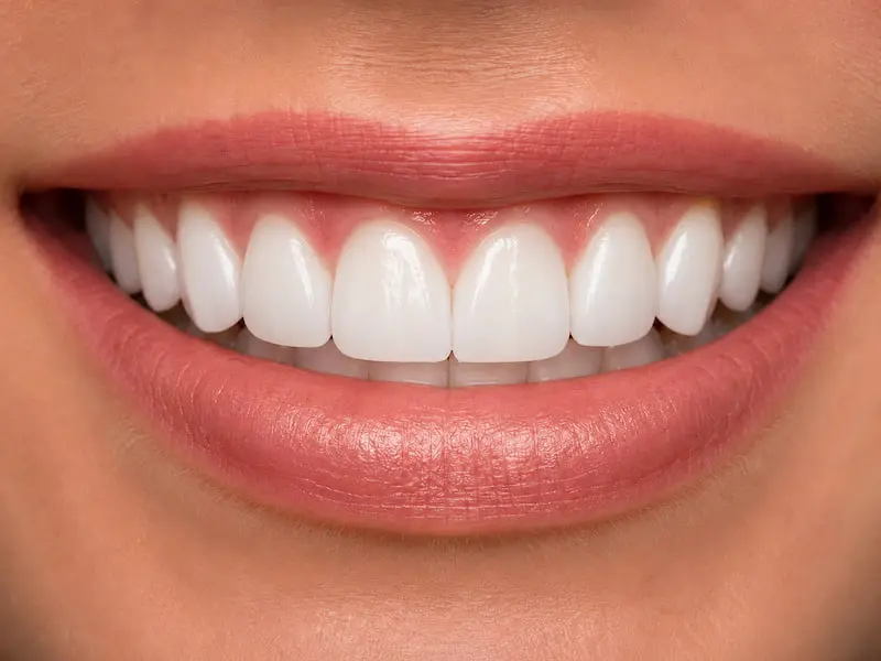 internal-bleaching-tijuana-after Upper central incisor after internal bleaching treatment in Tijuana