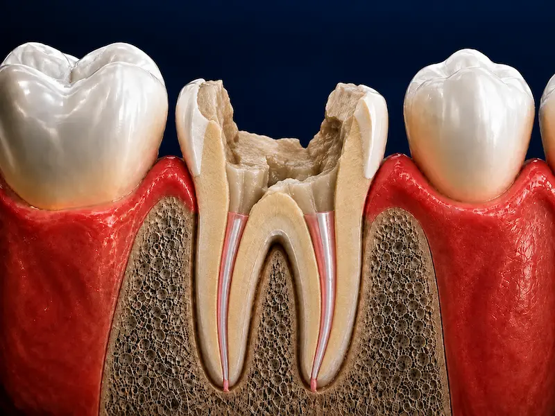 Post & Core Build-Up in Tijuana - Before Root canal-treated tooth with major structural damage before post and core build-up in Tijuana