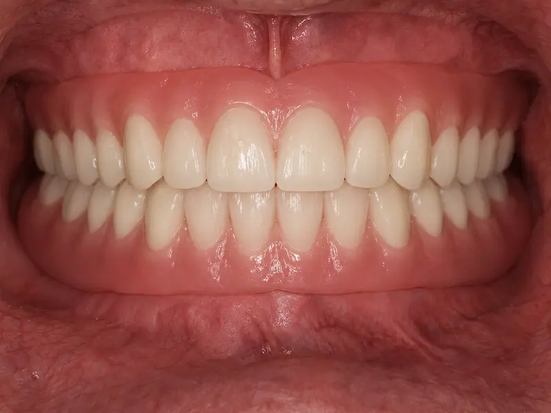 removable-dentures-tijuana-after Upper and lower removable dentures after removable dentistry treatment in Tijuana
