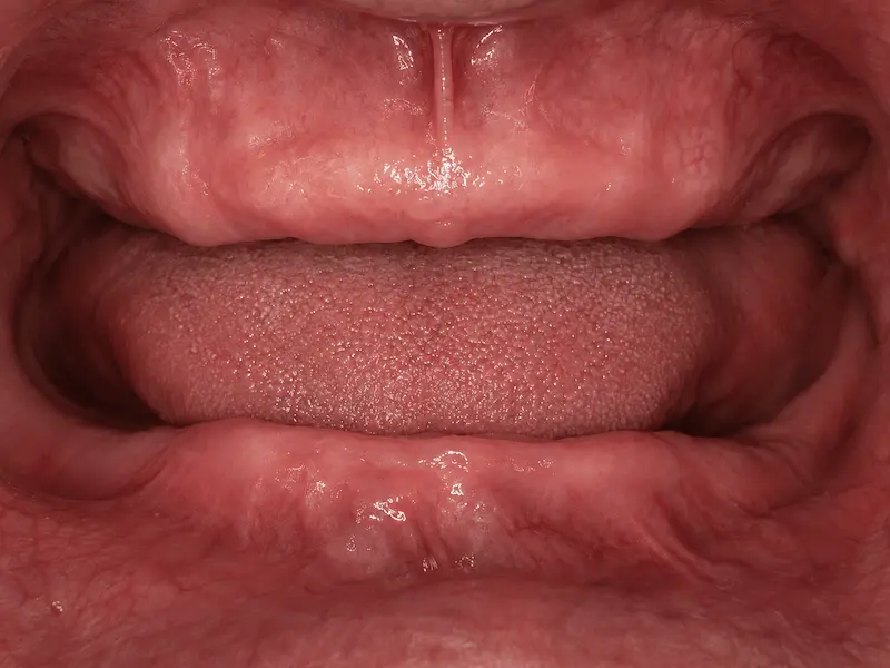 removable-dentures-tijuana-before Edentulous mouth before removable dentistry treatment in Tijuana