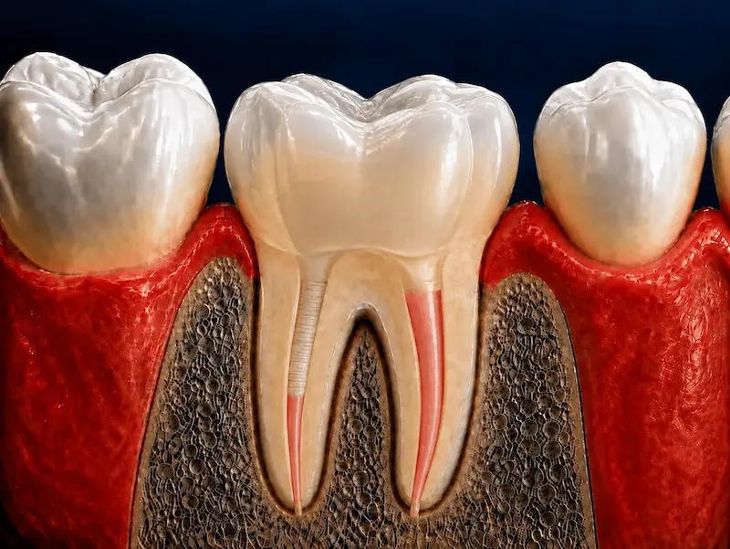 root-canal-crown-tijuana-after Root canal-treated tooth restored with a dental crown in Tijuana