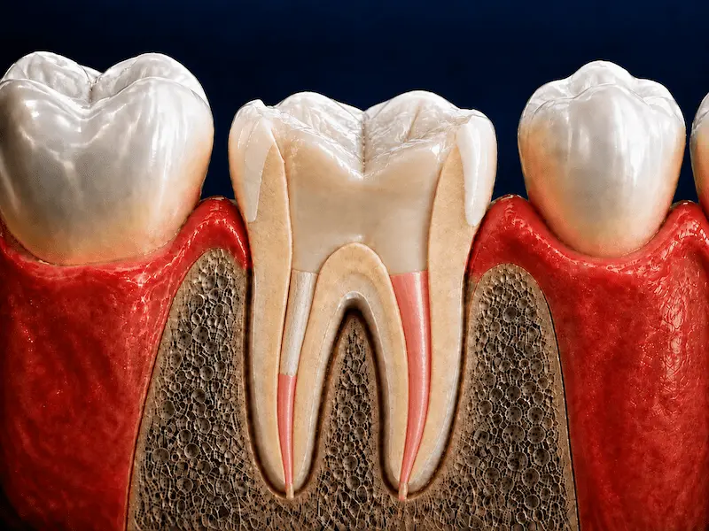 root-canal-crown-tijuana-before Root canal-treated tooth with post and core before crown placement in Tijuana