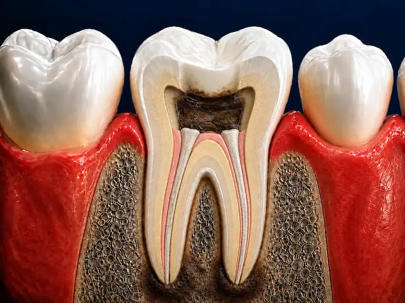Root Canal Retreatment in Tijuana - Before Previously treated root canal with reinfection and periapical lesion in Tijuana