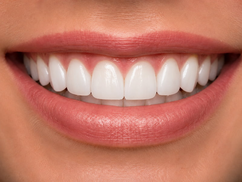 veneers-tijuana-after Front teeth restored with natural-looking porcelain veneers in Tijuana